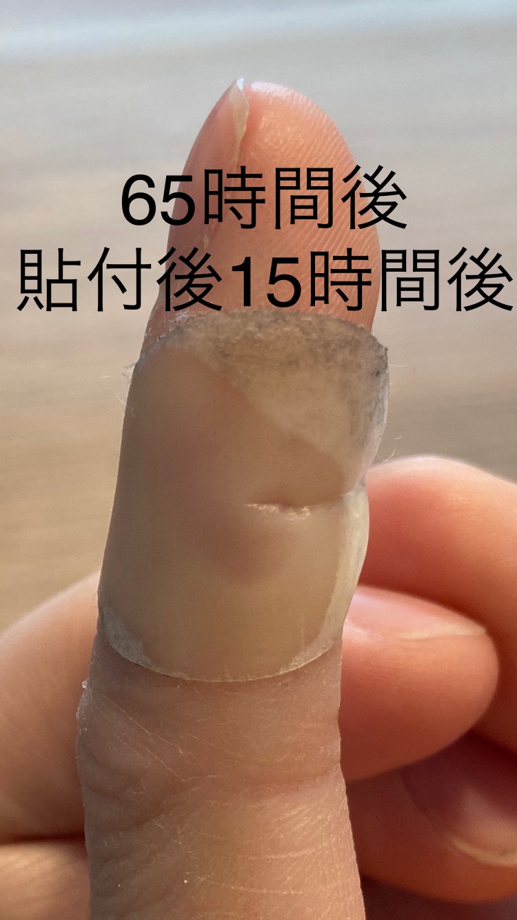 野球マメの最速治療4選 野球好き薬剤師がハイドロコロイド製剤を使ってみた 岡崎市周辺で野球がやりたくなるブログ 野球マメの最速治療4選 野球好き薬剤師がハイドロコロイド製剤を使ってみた 岡崎市周辺で野球がやりたくなるブログ