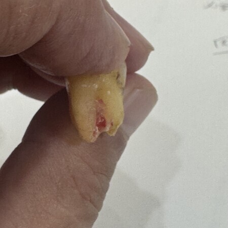 The root of the right 7th tooth... The right side is shorter because it has melted away.