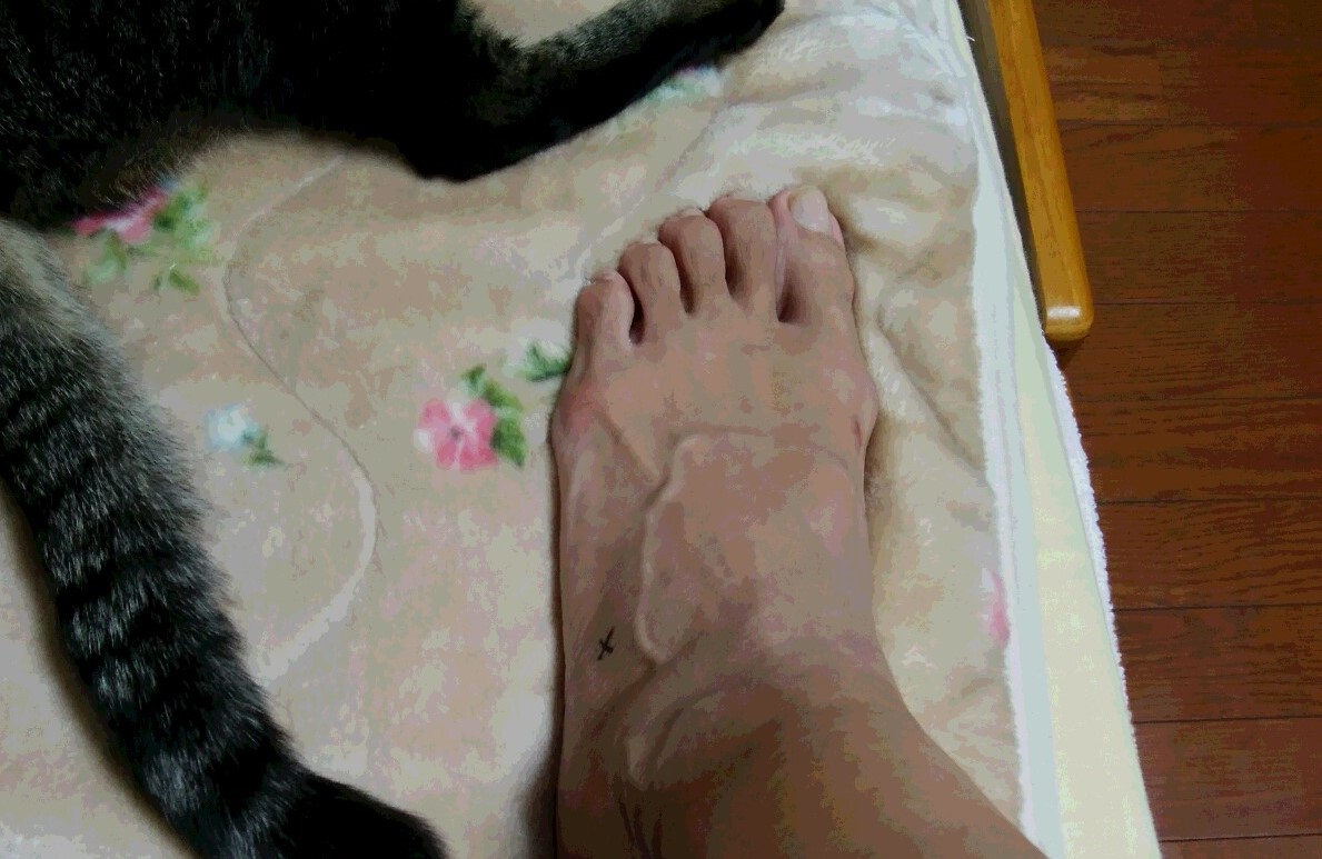 テーピングと皮膚損傷 Momotorakame S Blog