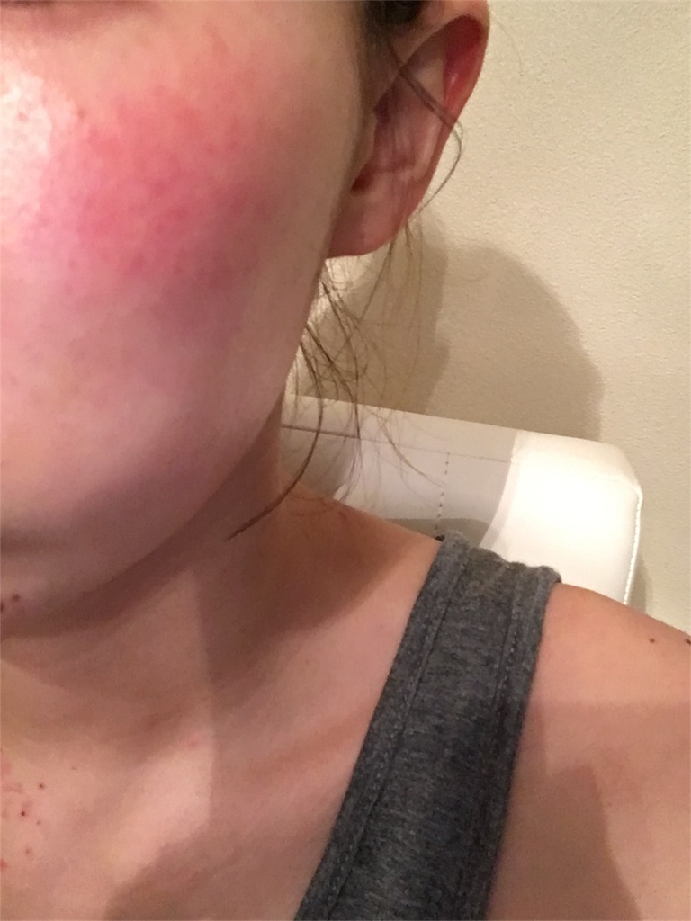 赤ら顔 赤ら顔治療経過 Vビームレーザーと ームクリーム 1日目 美容オタクのブログ