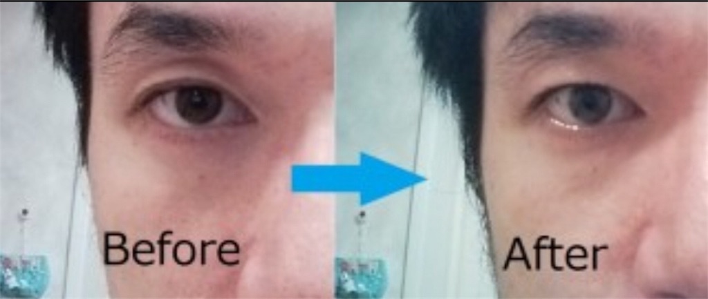 目のくぼみを治す7つの方法 美容オタクのブログ
