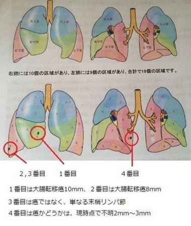 転移性肺がん切除状況