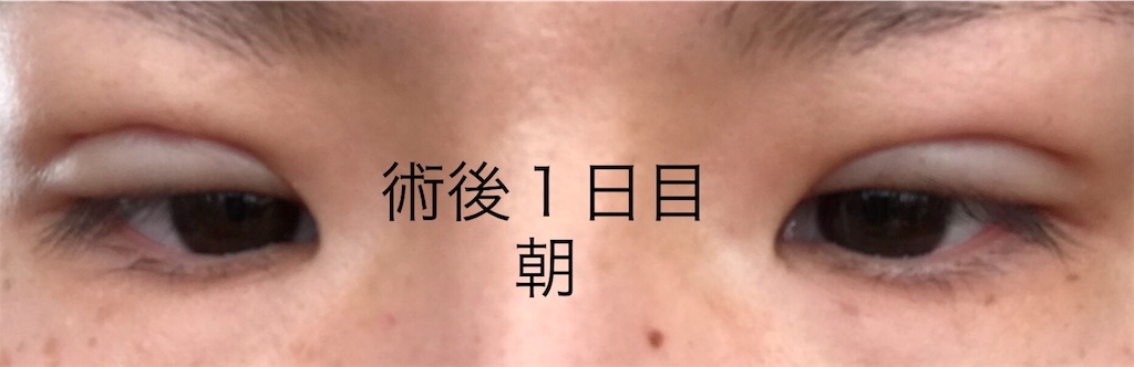 術後1日目 とにかく痛い 湘南美容外科クリニックでフォーエバー二重術を受けたアラサーの経過ブログ 術後1日目 とにかく痛い 湘南美容外科クリニックでフォーエバー二重術を受けたアラサーの経過ブログ