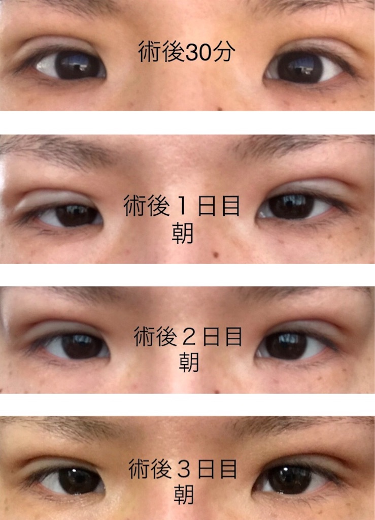 湘南美容外科クリニックでフォーエバー二重術を受けたアラサーの経過ブログ 湘南美容外科クリニックでフォーエバー二重術を受けたアラサーの経過ブログ