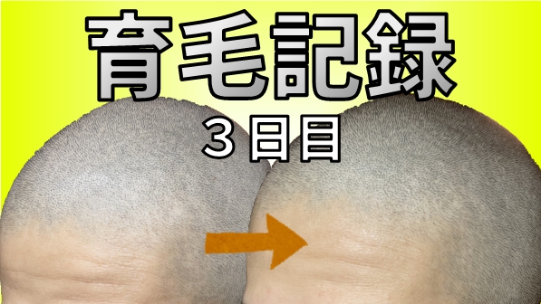 スキンヘッド育毛記録 ３日目 Dadgadlad
