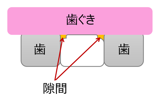 ブリッジした歯の隙間