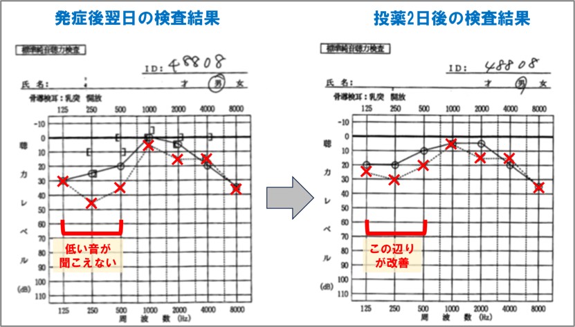 １－２－聴力検査の結果ー突発性難聴を発症後と投薬2日後の変化