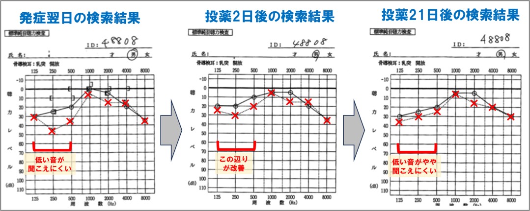 ３－２－突発性難聴発症から投薬後21日までの推移