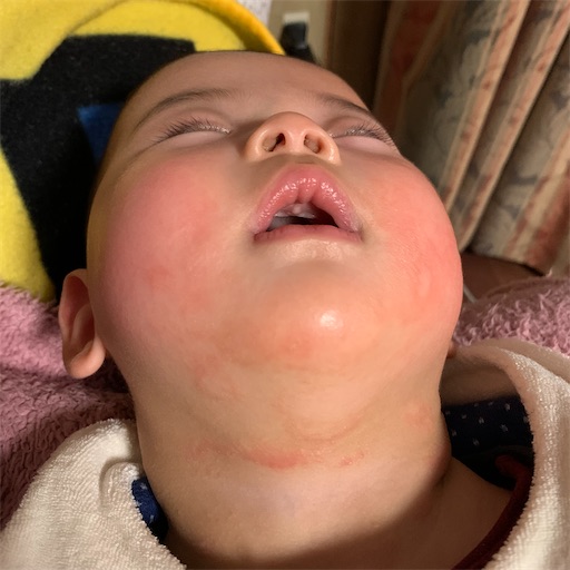 セナの肌のこと よだれかぶれ あやかさん家 島暮らしするってよ