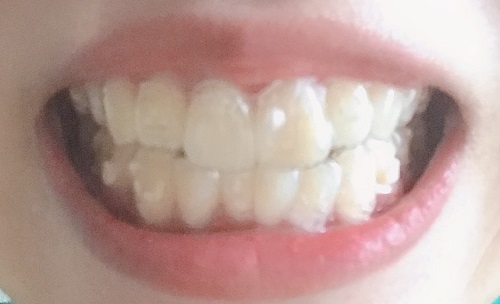 f:id:naitooth:20191012160120j:plain f:id:naitooth:20191012160120j:plain