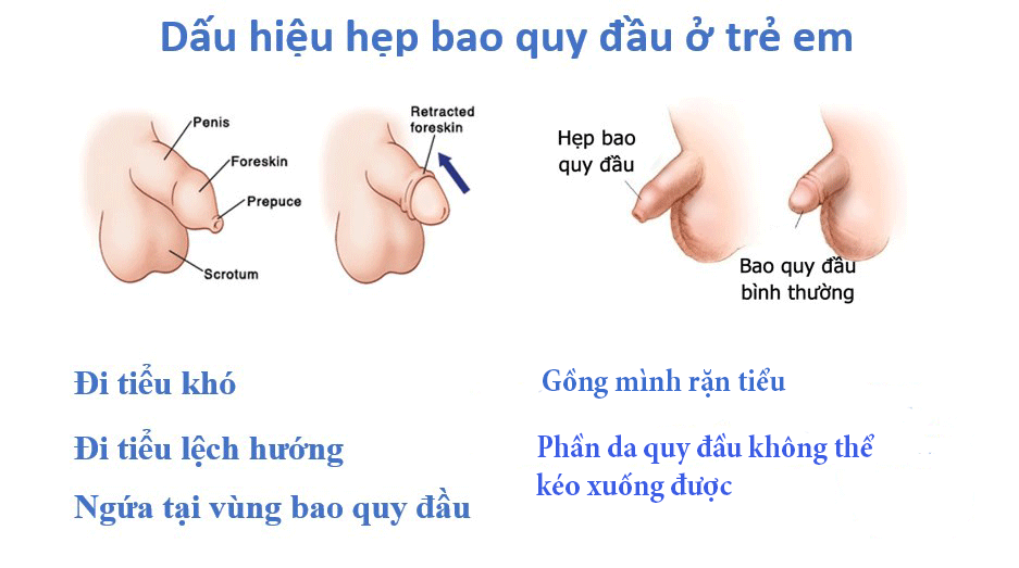 Dịch vụ cho mẹ và bé: Hẹp bao quy đầu ở trẻ em là gì ? 20191112134846