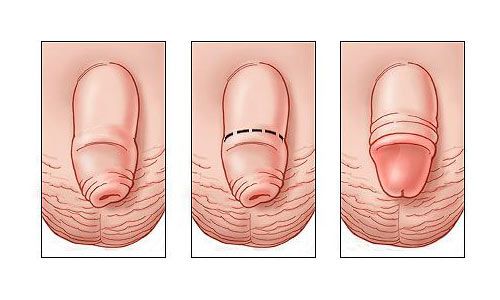 Dịch vụ cho mẹ và bé: Hẹp bao quy đầu ở trẻ em là gì ? 20191112134950