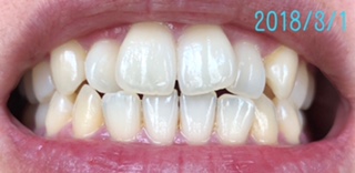 f:id:nanana38go:20180321203311j:plain