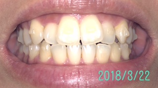 f:id:nanana38go:20180321203354j:plain