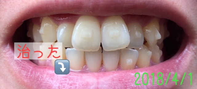 f:id:nanana38go:20180331213657j:plain