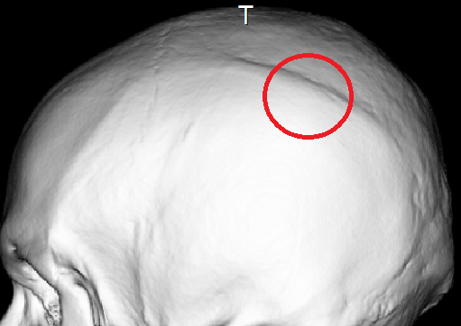 頭蓋骨縫合早期癒合症 Craniosynostosis Japaneseclass Jp