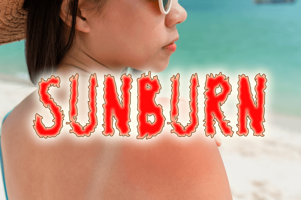 sunburn, オンライン英会話, 日焼け