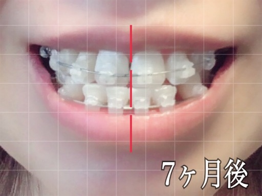 歯科矯正開始から7ヶ月後の様子