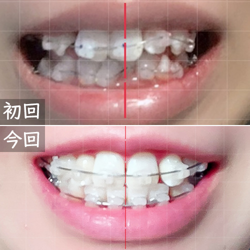 ワイヤー矯正開始頃との比較