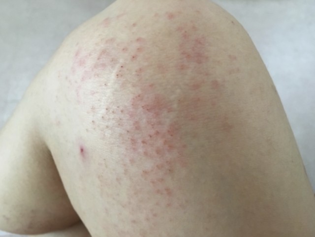 皮膚がんの症状