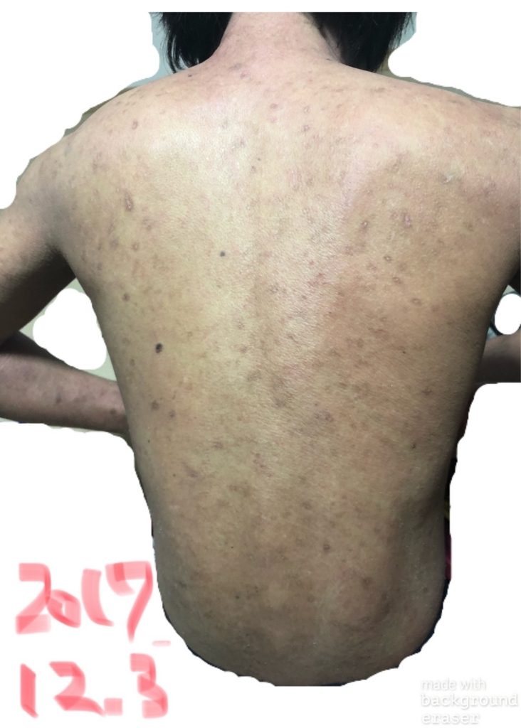 アトピー肌の症状改善写真 足 背中編 アトピーを完治させる旅