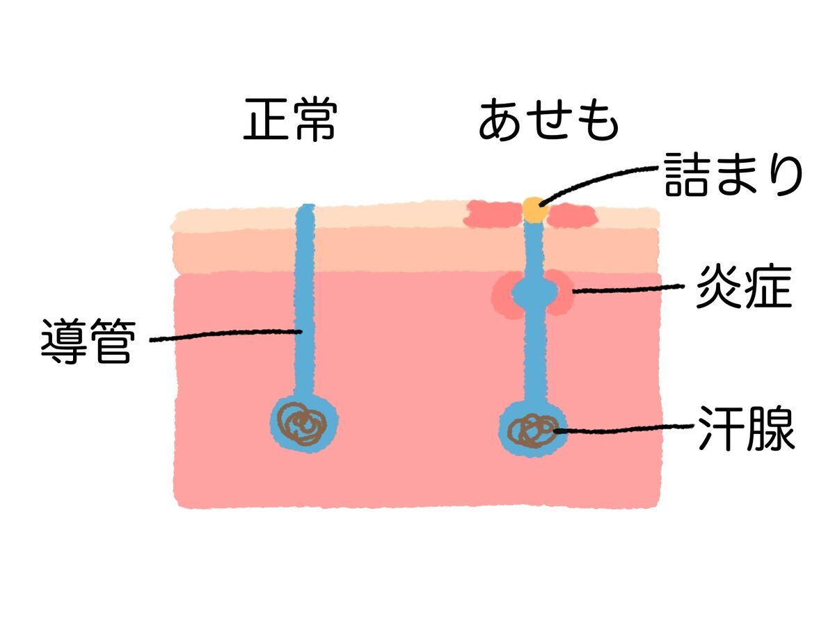 あせものメカニズム