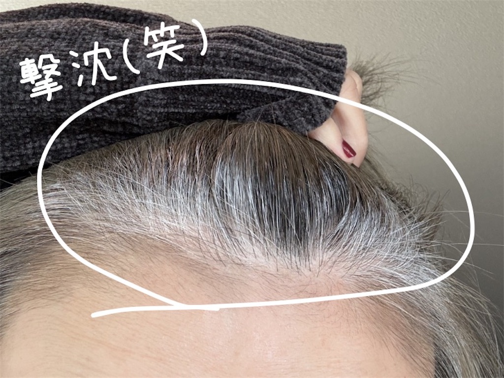 前髪が白髪だらけの写真