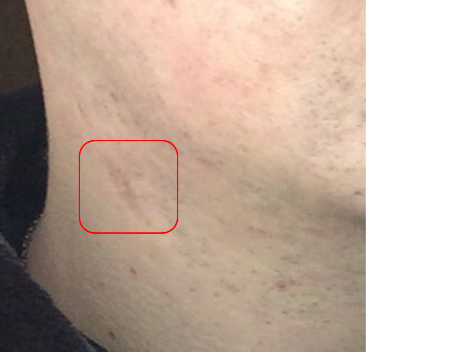 首ニキビが悪化してケロイドになったら打つ手はもうない ネックアクネラボ ニキ助の考察