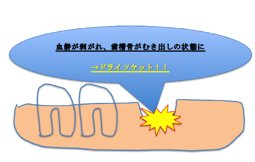 f:id:ninjalifegudaguda:20190121202200p:plain f:id:ninjalifegudaguda:20190121202200p:plain