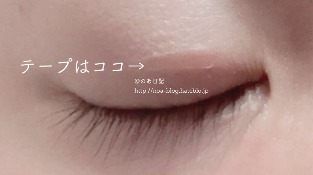 片目だけひとえの私が湘南美容アイリッドテープで整形級ふたえに挑戦してみた のあ日記
