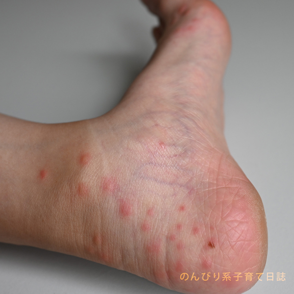 虫刺されで両足首が悲惨なことに のんびり系子育て日誌