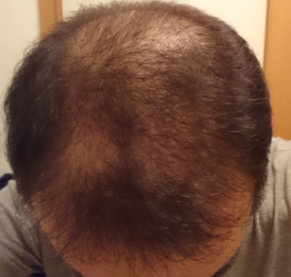 薄毛 イワシ缶詰で対策 1か月がたって 50代父さん のり蔵 の ご提案