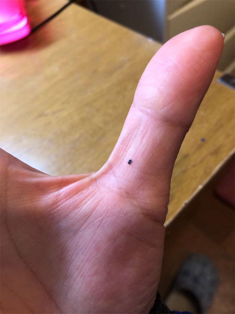 メラノーマ さてさて どこまで老けるか