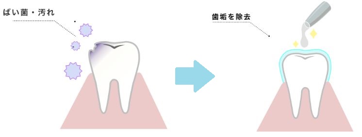 ミーズなら虫歯予防もできるホワイトニングエッセンス