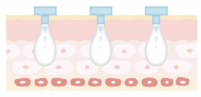 ヨルダは汗腺にふたをして汗をブロック