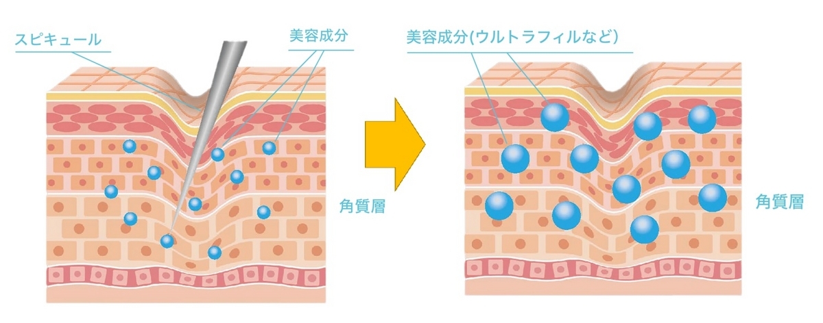 針で刺激された肌に保湿成分が入り込む