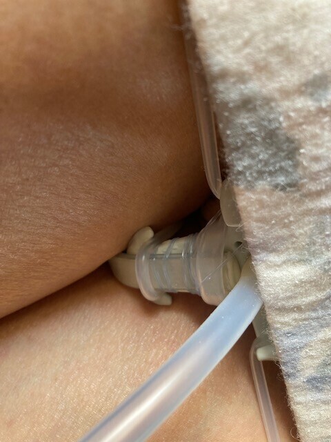Urine stopper at the end of the external collection tube