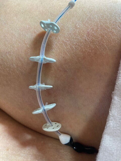 Connected mesh stoppers during downward wear and overnight prostate chip testing