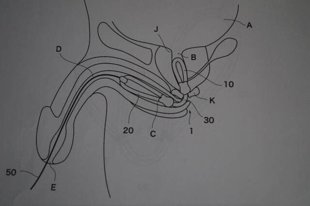 チップレス尿道留置具の申請を紹介する掲載画像