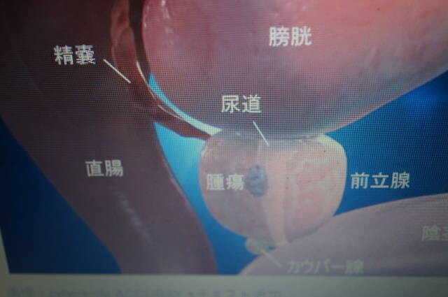 膀胱ループと二つの耳を組み合わせた試作形状の写真