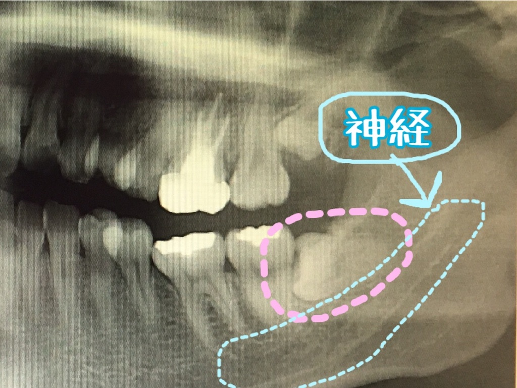 f:id:oki-gura:20190316120953j:plain f:id:oki-gura:20190316120953j:plain