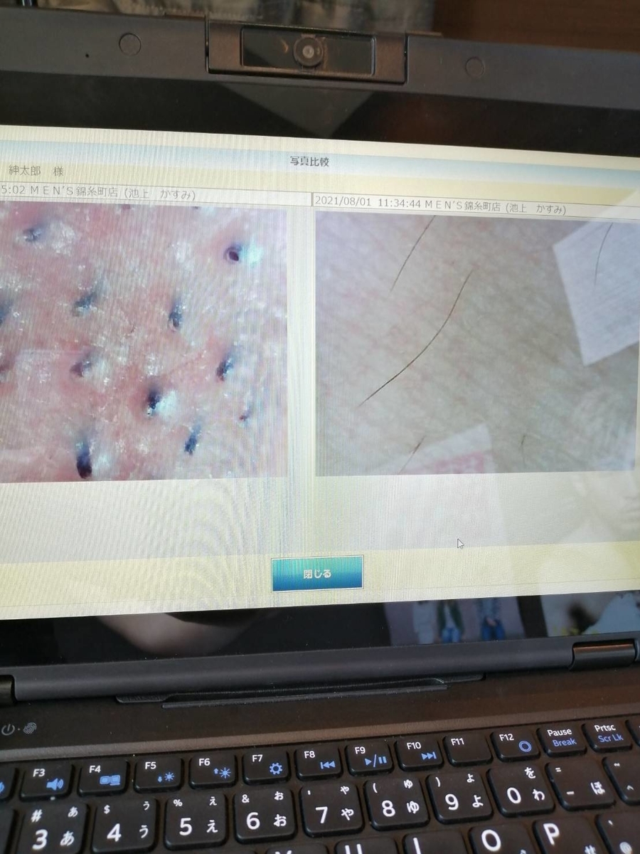 メンズTBCのヒゲ脱毛体験に行ってきました【口コミ】