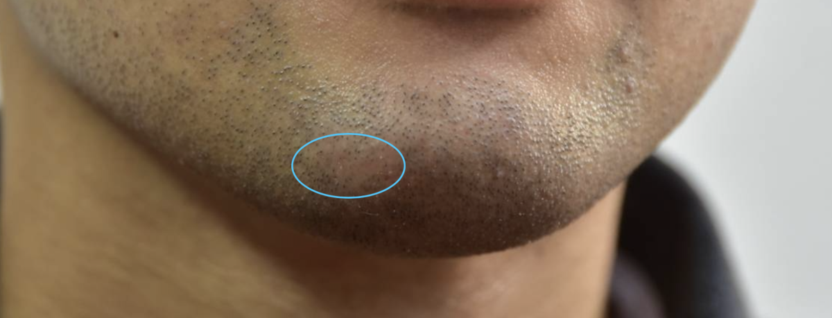 メンズTBCのヒゲ脱毛体験に行ってきました【口コミ】