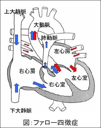 ファロー四徴症の概念図