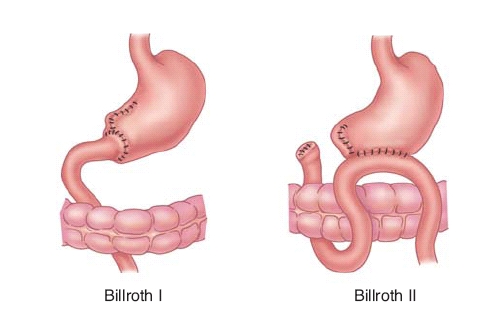 billroth1と2