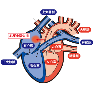 心房中隔欠損症