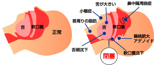 睡眠時無呼吸症候群のメカニズム