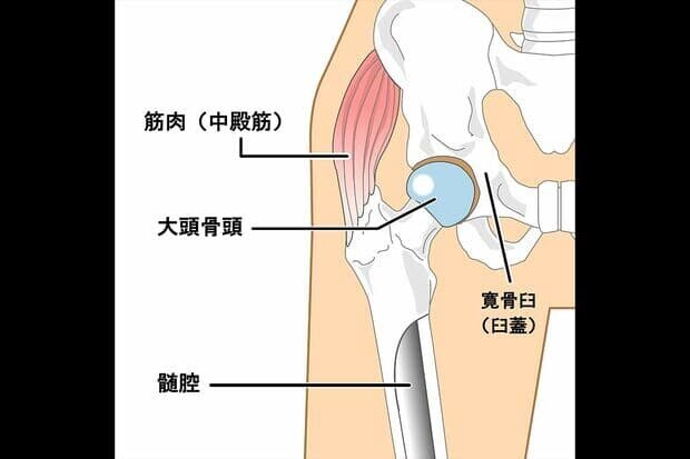 股関節手術