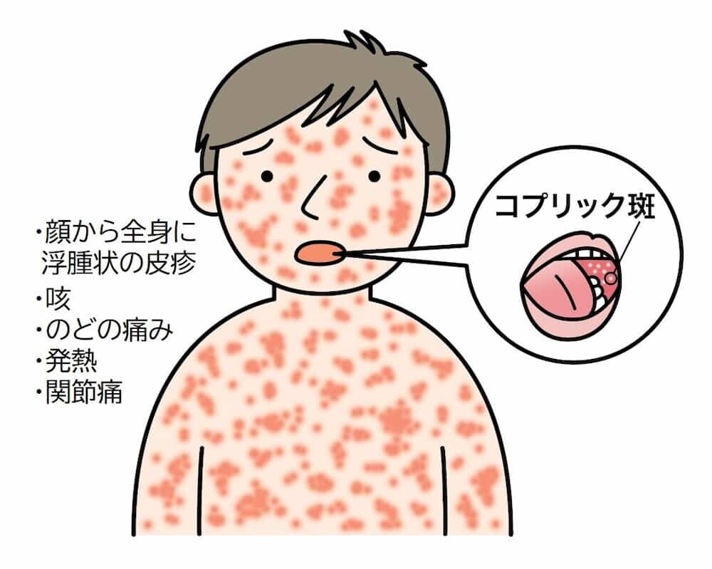 はしか