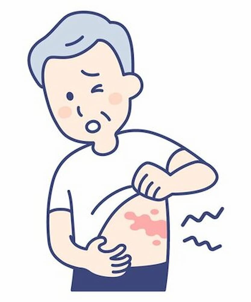 帯状疱疹 症状 イラスト